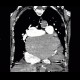 Pulmonary embolism, pulmonary hypertension, cardiomegally, correlation: CT - Computed tomography